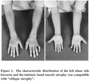 After the accident, the nerves to her arm were damaged and so the muscles ________ through disuse.