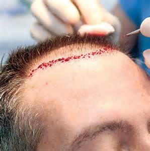 My uncle is <u>re-seeding</u> his head with hair because of his _______ hair line.
